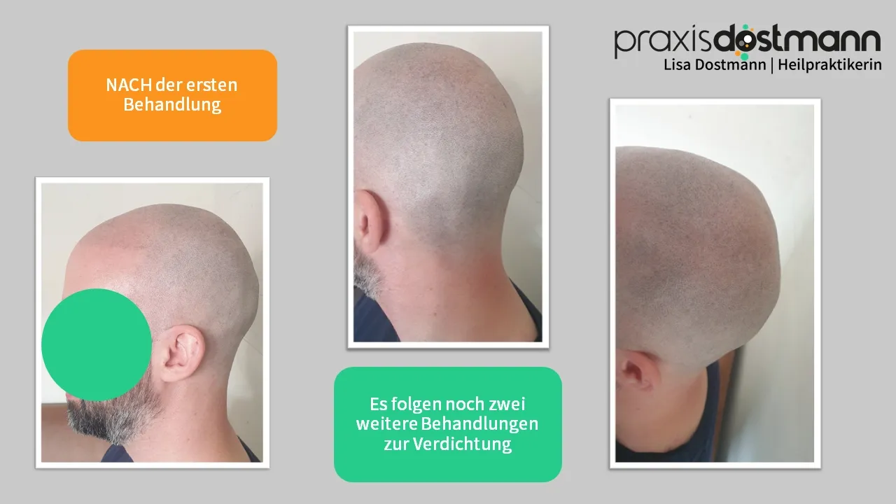 Nach der ersten Behandlung: Der Haaransatz wurde harmonisch nach vorn verlagert, die kahlen Stellen aufgefüllt. Es sieht aus als wären überall Haarstoppeln vorhanden.